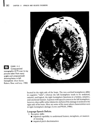 CHAPTER APHASIA AND RELATED DISORDERS
FIGURE II-?
Computerized
tomographic (CT) scan (x-ray
pictures taken from many
angles and computerized)
showing lesion in left
hemisphere (from Seines,
Rubens, Risse, and Levy, 1982)
located in the right side of the brain. The two cerebral hemispheres differ
in cognitive "style"; whereas the left hemisphere tends to be analytical,
rational, and logical, the right hemisphere functions in a holistic, intuitive,
and emotional manner. A person with speech centers in the left hemisphere,
however, does suffer rather distinctive deficits if the damage is isolated in the
right side of his brain. Here are some of the most salient characteristics seen
in right-hemisphere damage (Lowe and Webb, 1986).
Language-Speech Deficits.
1. Receptive skills:
• impaired capability to understand humor, metaphors, or nuances
of meaning
• impaired pitch discrimination
 