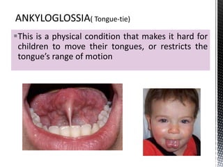 This is a physical condition that makes it hard for
children to move their tongues, or restricts the
tongue’s range of motion
 