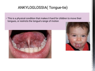  This is a physical condition that makes it hard for children to move their
tongues, or restricts the tongue’s range of motion
ANKYLOGLOSSIA( Tongue-tie)
 