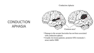 CONDUCTION
APHASIA
 