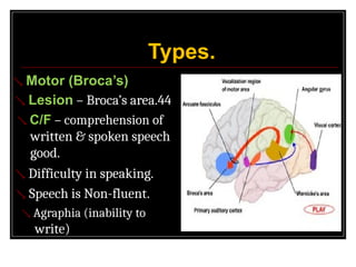 Types.
Thursday, March 24, 2016 HIGHER FUNCTIONS OF BRAIN. 26
 Motor (Broca’s)
 Lesion – Broca’s area.44
 C/F – comprehension of
written & spoken speech
good.
 Difficulty in speaking.
 Speech is Non-fluent.
 Agraphia (inability to
write)
 