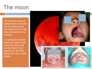 The moon
•If a women craves a
certain food a lot when
she is pregnant and
she eats a lot of it, her
baby will look like her
craving.
•If a pregnant women
goes out during a full
moon the moon will
eat her baby’s face
resulting in the baby
being born with a cleft
palate.
 