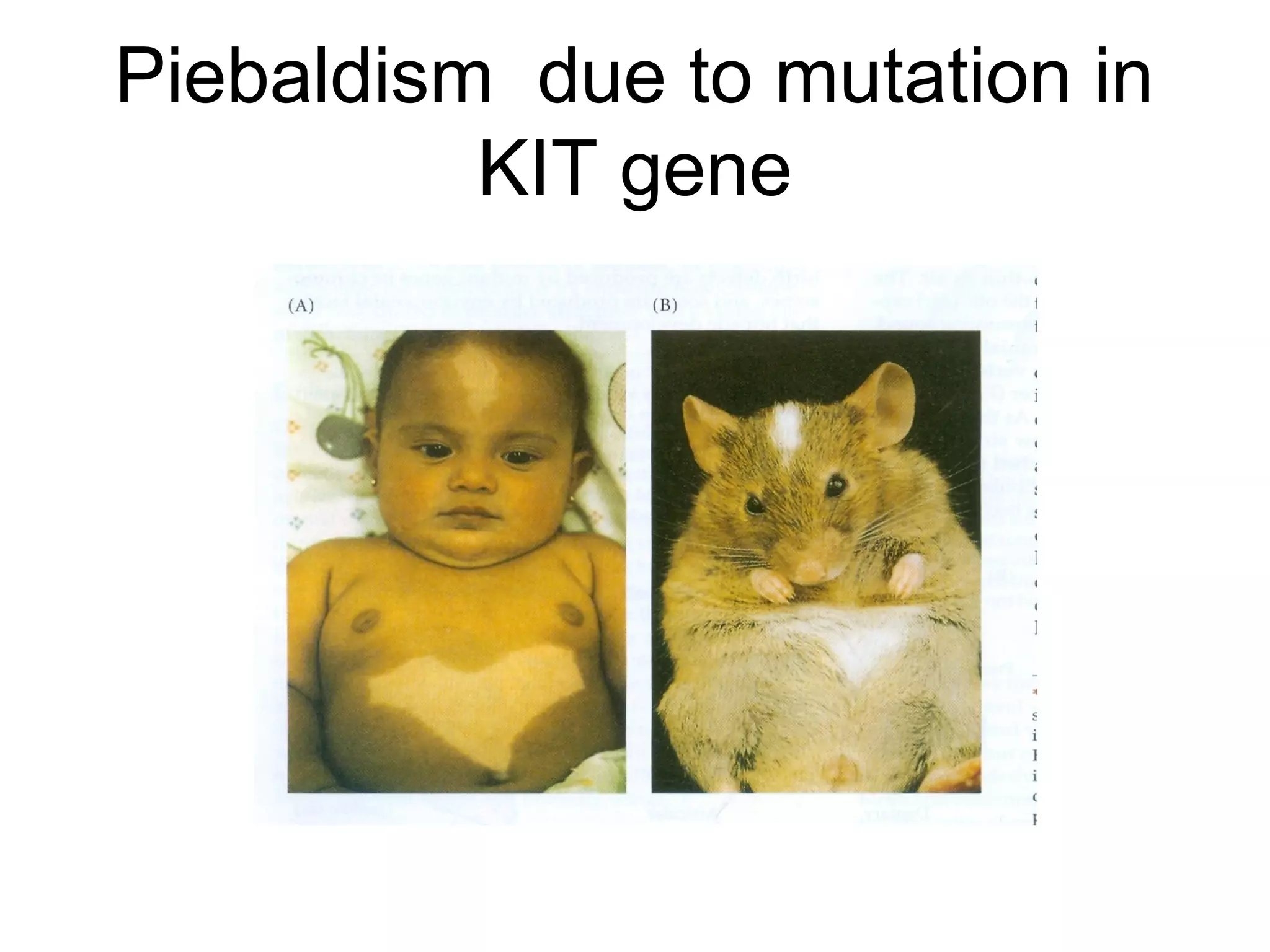 Piebaldism due to mutation in
          KIT gene
 