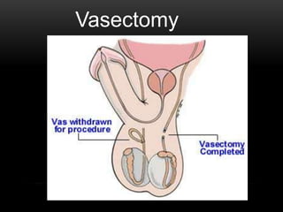 Vasectomy
 