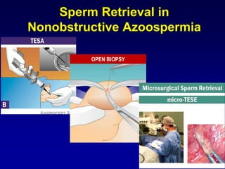 Sperm Retrieval in
Nonobstructive Azoospermia

         OPEN BIOPSY
 