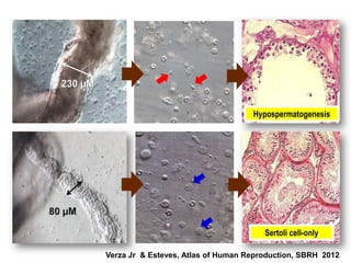 Hypospermatogenesis




                                       Sertoli cell-only

Verza Jr & Esteves, Atlas of Human Reproduction, SBRH 2012
 