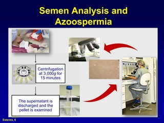 Semen Analysis and
                          Azoospermia




                       Centrifugation
                       at 3,000g for
                        15 minutes




             The supernatant is
             discharged and the
             pellet is examined

Esteves, 6
 