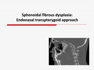 Sphenoidal fibrous dysplasia:
Endonasal transpterygoid approach
 