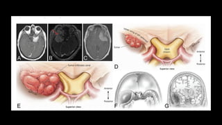 Sphenoid Wing, Sphenoorbital, Clinoidal,.pptx