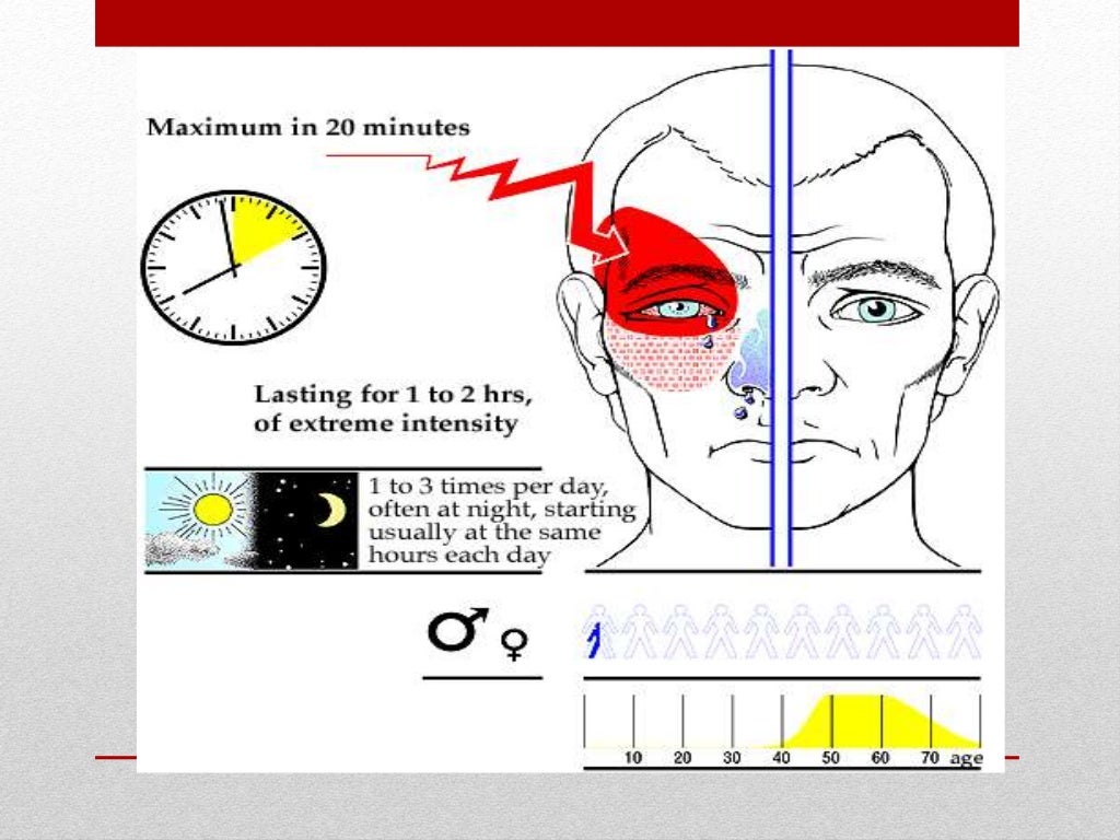 Sphenopalatine Neuralgia