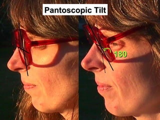 35
Pantoscopic TiltPantoscopic Tilt
180180
 