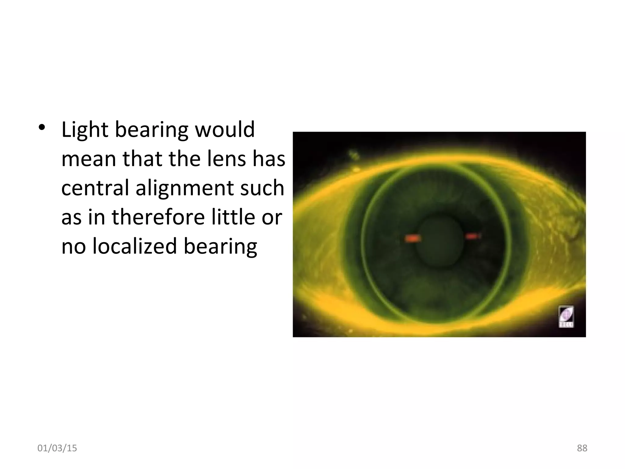 Spherical RGP contact lens fitting and prescribing