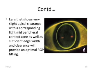 Contd…
• Lens that shows very
slight apical clearance
with a corresponding
light mid peripheral
contact zone as well as
su...