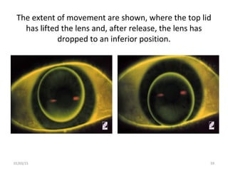 The extent of movement are shown, where the top lid
has lifted the lens and, after release, the lens has
dropped to an inf...