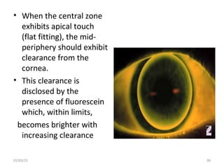 • When the central zone
exhibits apical touch
(flat fitting), the mid-
periphery should exhibit
clearance from the
cornea....