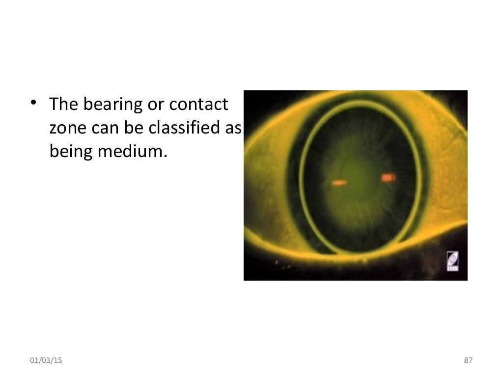 Spherical RGP contact lens fitting and prescribing