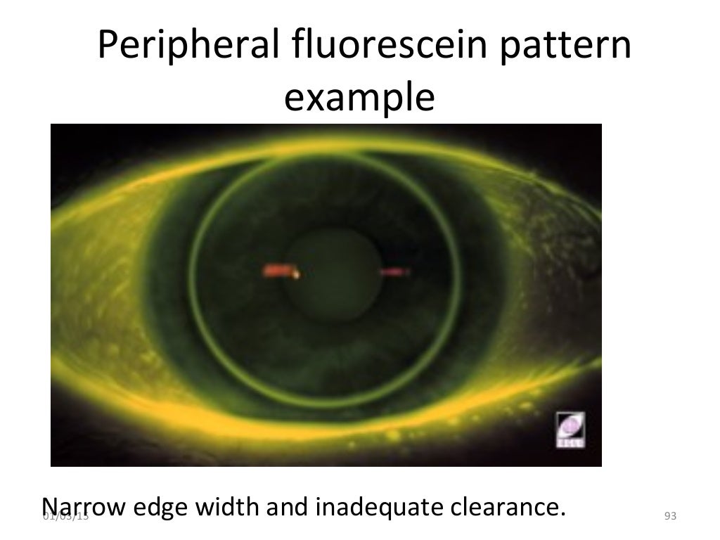 Spherical RGP contact lens fitting and prescribing