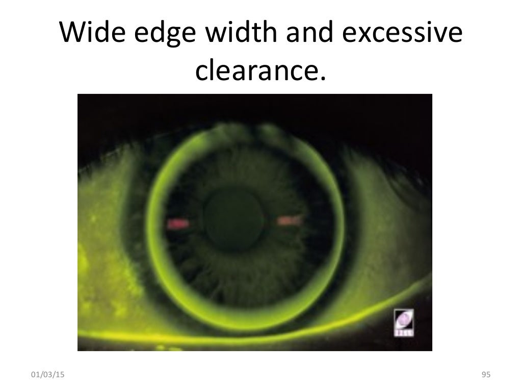 Spherical RGP contact lens fitting and prescribing