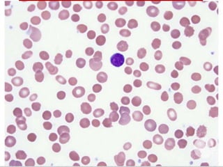 Spherocytes significance and differential diagnosis | PPTX