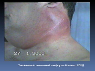 Увеличенный затылочный лимфоузел больного СПИД
 