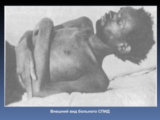Внешний вид больного СПИД
 