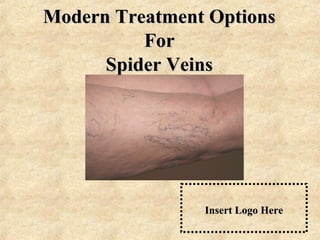 Modern Treatment OptionsModern Treatment Options
ForFor
Spider VeinsSpider Veins
Insert Logo HereInsert Logo Here
 