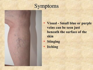 SymptomsSymptoms
• Visual - Small blue or purple
veins can be seen just
beneath the surface of the
skin
• Stinging
• Itchi...