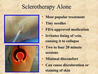 Sclerotherapy AloneSclerotherapy Alone
• Most popular treatment
• Tiny needles
• FDA-approved medication
• Irritates linin...