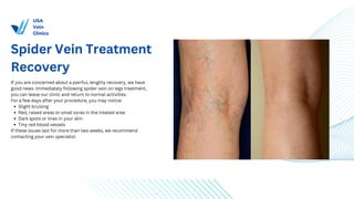 SPIDER VEIN TREATMENT.pdf