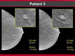 Digital Breast Tomosynthesis with Minimal Compression Slide 21