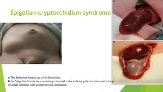 Spigelian-cryptorchidism syndrome
a The Spigelian hernia sac after dissection,
b the Spigelian hernia sac containing a normal testis without gubernaculum and a loop
of small intestine with compromised circulation
 