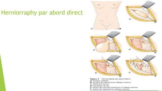 Herniorraphy par abord direct
 