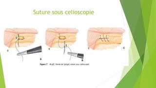 Suture sous celioscopie
 