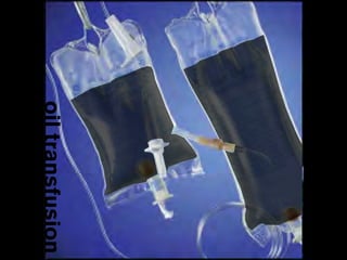 oil transfusion
 