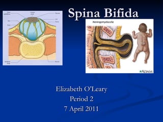 Spina Bifida Elizabeth O’Leary Period 2 7 April 2011 