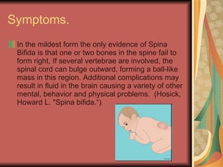 Symptoms.  In the mildest form the only evidence of Spina Bifida is that one or two bones in the spine fail to form right, If several vertebrae are involved, the spinal cord can bulge outward, forming a ball-like mass in this region. Additional complications may result in fluid in the brain causing a variety of other mental, behavior and physical problems.  (Hosick, Howard L. "Spina bifida.“) 