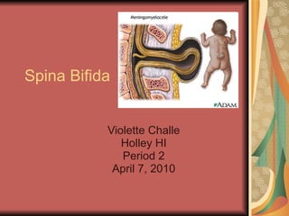 Spina Bifida Violette Challe Holley HI Period 2 April 7, 2010 
