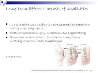 Long Term Effects/ Impacts of Disabilities As   I said before, Spina Bifida is a chronic condition, therefore it can’t be cured, only treated. Treatment includes: surgery, medication, and physiotherapy Throughout the individuals life, treatments may become necessary to prevent further complications Source: elibrary http://www.catherineshafer.com/images/jama_children_birthdefects_lev20_spinabifida_jpp_01_1_.jpg 