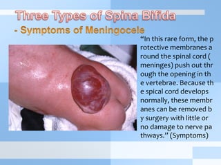 “In	
  this	
  rare	
  form,	
  the	
  p
rotective	
  membranes	
  a
round	
  the	
  spinal	
  cord	
  (
meninges)	
  push	
  out	
  thr
ough	
  the	
  opening	
  in	
  th
e	
  vertebrae.	
  Because	
  th
e	
  spical	
  cord	
  develops	
  
normally,	
  these	
  membr
anes	
  can	
  be	
  removed	
  b
y	
  surgery	
  with	
  little	
  or	
  
no	
  damage	
  to	
  nerve	
  pa
thways.”	
  (Symptoms)	
  
 