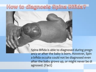 Spina	
  Biﬁda	
  is	
  able	
  to	
  diagnosed	
  during	
  pregn
ancy	
  or	
  after	
  the	
  baby	
  is	
  born.	
  However,	
  Spin
a	
  biﬁda	
  occulta	
  could	
  not	
  be	
  diagnosed	
  even	
  
after	
  the	
  baby	
  grows	
  up,	
  or	
  might	
  never	
  be	
  di
agnosed.	
  (Fact)
 