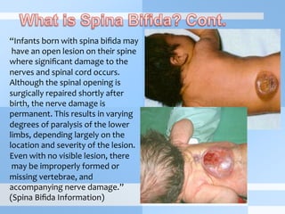 “Infants	
  born	
  with	
  spina	
  biﬁda	
  may
	
  have	
  an	
  open	
  lesion	
  on	
  their	
  spine	
  
where	
  signiﬁcant	
  damage	
  to	
  the	
  	
  
nerves	
  and	
  spinal	
  cord	
  occurs.	
  	
  
Although	
  the	
  spinal	
  opening	
  is	
  	
  
surgically	
  repaired	
  shortly	
  after	
  	
  
birth,	
  the	
  nerve	
  damage	
  is	
  	
  
permanent.	
  This	
  results	
  in	
  varying	
  	
  
degrees	
  of	
  paralysis	
  of	
  the	
  lower	
  	
  
limbs,	
  depending	
  largely	
  on	
  the	
  	
  
location	
  and	
  severity	
  of	
  the	
  lesion.	
  
Even	
  with	
  no	
  visible	
  lesion,	
  there	
  
	
  may	
  be	
  improperly	
  formed	
  or	
  	
  
missing	
  vertebrae,	
  and	
  	
  
accompanying	
  nerve	
  damage.”	
  
(Spina	
  Biﬁda	
  Information)	
  
 