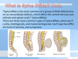 “Spina	
  biﬁda	
  is	
  the	
  most	
  common	
  of	
  a	
  group	
  of	
  birth	
  defects	
  kno
wn	
  as	
  newuraltube	
  defects,	
  which	
  aﬀect	
  the	
  central	
  nervous	
  syst
m(brain	
  and	
  spinal	
  cord).”	
  (Spina	
  Biﬁda)	
  
There	
  are	
  three	
  most	
  common	
  types	
  of	
  Spina	
  Biﬁda,	
  which	
  are	
  O
cculta,	
  meningocele,	
  and	
  myelomeningocele.	
  Each	
  type	
  has	
  diﬀer
ent	
  level	
  of	
  severity,	
  and	
  symptoms.	
  
 