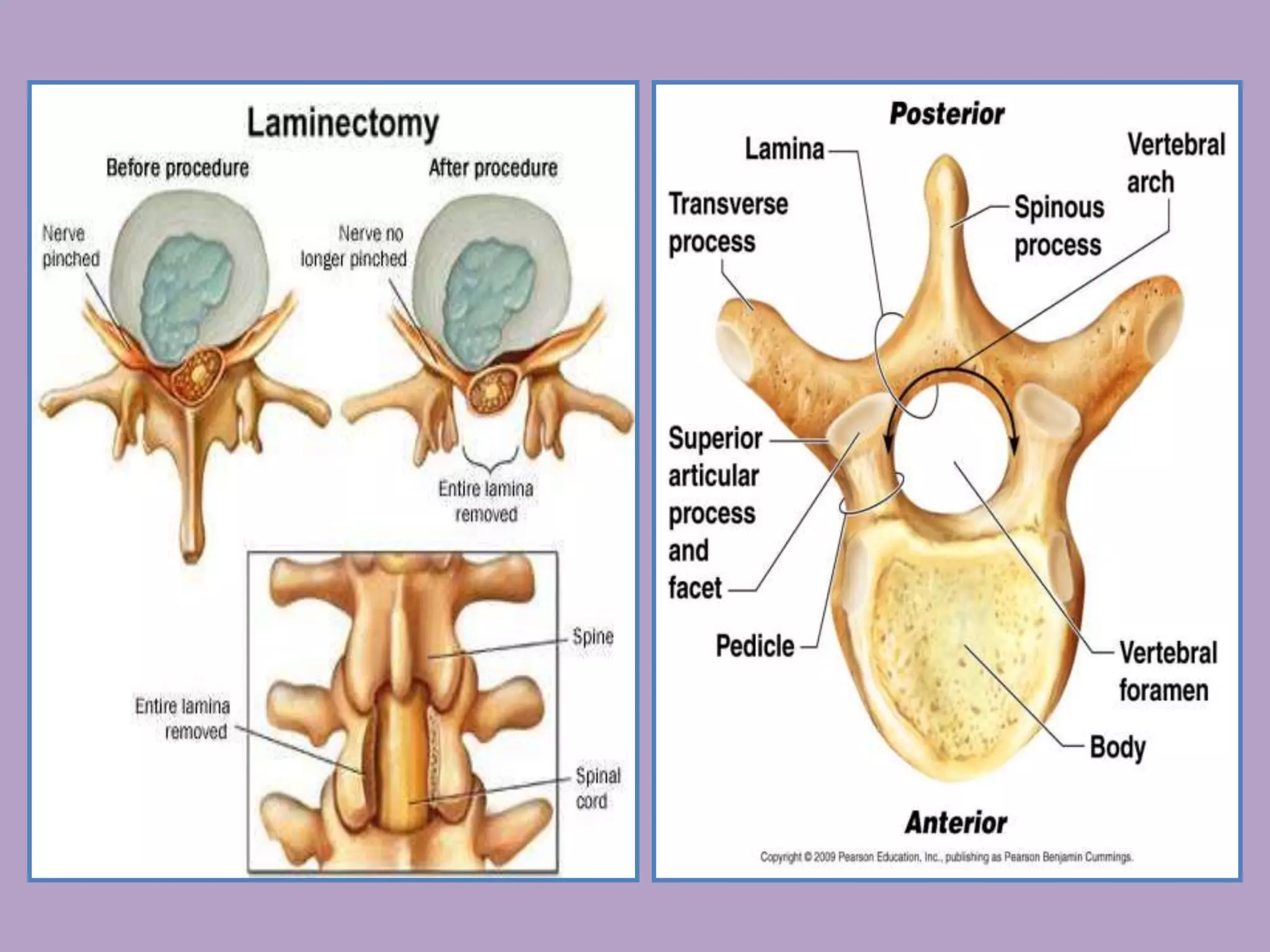 Spina bifida Neurological disorder | PPT
