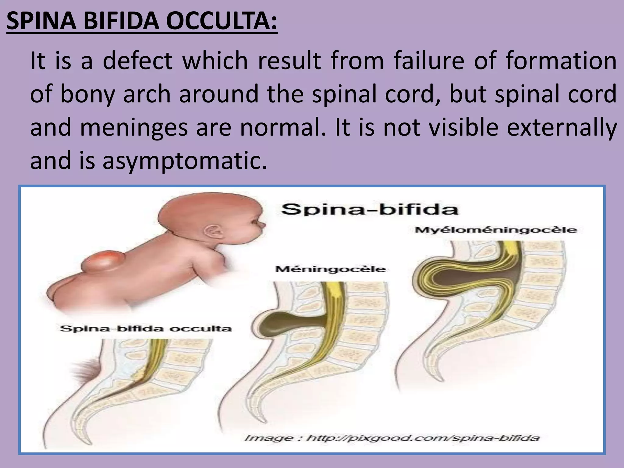 Spina bifida Neurological disorder | PPTX