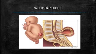 MYELOMENINGOCELE
 