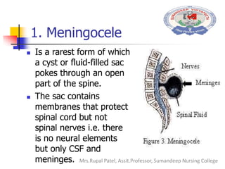 1. Meningocele
 Is a rarest form of which
a cyst or fluid-filled sac
pokes through an open
part of the spine.
 The sac contains
membranes that protect
spinal cord but not
spinal nerves i.e. there
is no neural elements
but only CSF and
meninges. Mrs.Rupal Patel, Assit.Professor, Sumandeep Nursing College
 