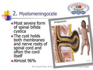 2. Myelomeningocele
 Most severe form
of spinal bifida
cystica
 The cyst holds
both membranes
and nerve roots of
spinal cord and
often the cord
itself
 Almost 96%
Mrs.Rupal Patel, Assit.Professor, Sumandeep Nursing College
 