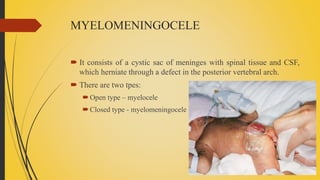 MYELOMENINGOCELE
 It consists of a cystic sac of meninges with spinal tissue and CSF,
which herniate through a defect in the posterior vertebral arch.
 There are two tpes:
Open type – myelocele
Closed type - myelomeningocele
 