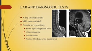 LAB AND DAIGNOSTIC TESTS
 X-ray spine and skull.
 MRI spine and skull.
 Prenatal screening tests
Serum alpha fetoprotein level
Ultrasonography
Amniocentesis
Routine blood and urine examination
 