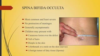 SPINA BIFIDA OCCULTA
 Most common and least severe
 No protrusion of meninges
 Generally asymptomatic
 Children may present with
Cutaneous lesion over the defect
Tuft of hairs
Dimple in the skin
A birthmark or a mole on the skin (naevus)
A benign tumor of fatty tissue (lipoma)
 